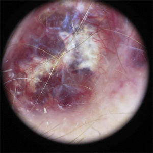 Dermatoscopic image showing a lesion with homogeneous red areas, irregular while-yellow structures, areas covered with a blue-white veil, irregular linear vessels on the periphery, and some chrysalides.