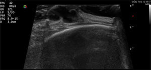 Skin ultrasound with a hypoechoic, lobulated lesion in the superficial dermis, with discrete posterior reinforcement.