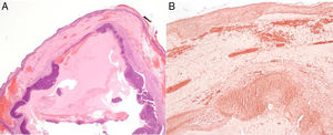 Histological image. Hematoxylin-eosin×20. A well-delimited pilomatrixoma can be seen beneath an edematous dermis with substantial blood extravasation (A) and complete absence of elastic fibers in staining with orcein (x100, B).