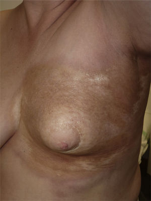 Notable reduction in left breast size. The plaque is highly indurated and well-demarcated. The skin surface is shiny, some areas are hyperpigmented while others are pearly, and adnexal structures are absent. Note the erythematous border surrounding the entire plaque.