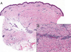 A, Low-magnification view showing decreased adnexal structures as well as an interstitial and mildly perivascular lymphoplasmacytic inflammatory infiltrate, both superficial and deep. Hematoxylin-eosin, original magnification ×40. B, Higher magnification shows collagen thickening. Hematoxylin-eosin, original magnification ×100.