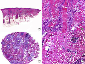 Longstanding pseudopelade of Brocq. A, Low-magnification view showing columns of fibrosis replacing the follicles (hematoxylin and eosin [HE] x10). B, Detail of the previous image showing vertical fibrosis mixed with actinic elastosis (HE x200). C, Transversal section of the same case, showing several follicular units (HE, X20). D, At higher magnification, concentric fibrosis around follicular remnants can be observed (HE x200).