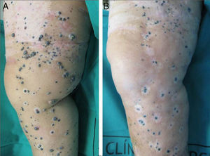 A, Explosive appearance of multiple cutaneous melanoma metastases on the lower limb. B, Clinical response 1 year after the application of electrochemotherapy. Note the halo nevus phenomenon, a frequent result of electrochemotherapy.