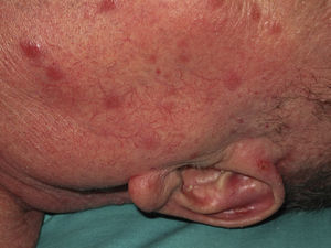 Cutaneous leishmaniasis with multiple lesions.