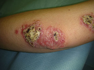 Multiple lesions in imported cutaneous leishmaniasis.