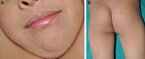 Patient 1. A, Facial lentigines. B, Hyperpigmented lesions of various sizes on the lower limbs; the largest was located on the right buttock.