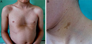 Patient 2. A, Pectus excavatum, a skeletal abnormality that is common in patients with mutations in the RAS-MAPK (rat sarcoma mitogen-activated protein kinase) pathway; hyperpigmented lenticular lesions on the trunk. B, Hyperpigmented macule with irregular borders along with multiple lentigines on the left side of the neck.