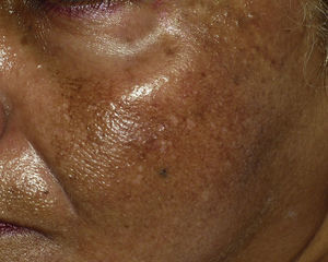 Clinical photograph of the patchy, granular hyperpigmentation present in the left temporal region.