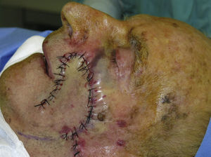 Immediate postoperative appearance; advancement-rotation flap for reconstruction of the surgical defect.