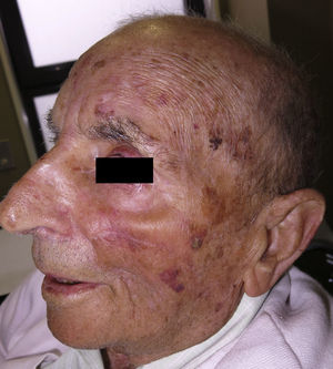 Eight weeks after surgery; the excellent functional and cosmetic result can be seen.