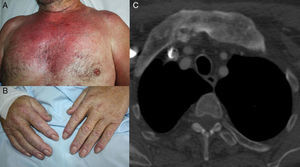 A and B, Skin lesions clinically compatible with dermatomyositis. C, As paraneoplastic dermatomyositis was suspected, a tumor-screening study was performed, which detected a resectable neoplastic lesion in the lung.
