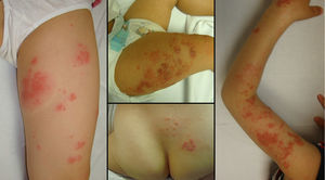 Clinical characteristics of the herpes zoster lesions in 4 of the patients in our series.