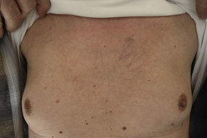 Telangiectasias on the left hemithorax. Examination revealed no other alterations. The rash described by the patient had resolved at the time of diagnosis.
