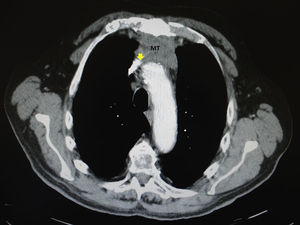 Computed tomography revealed a tumor in the anterior mediastinum (MT) with compression of the superior vena cava (arrow).