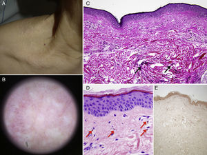 A, Millimetric nonfollicular papules, light brownish in color, converge to form plaques with a cobblestone pattern. B, Light-brownish areas tending to converge; multiple linear and branching vessels can be seen. C, Nearly total absence of elastic fibers in the papillary dermis; in contrast, elastic fibers (black arrows) can be seen in the reticular dermis (orcein, original magnification ×100). D, Melanophages (red arrows) dispersed in the papillary dermis (hematoxilin-eosin ×400). E, Von Kossa staining revealed no calcifications of elastic fibers (original magnification ×100).