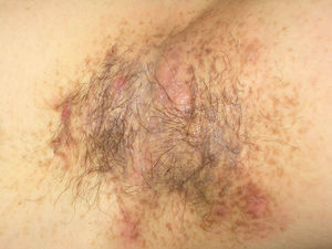 Axillary nodules with a seropurulent exudate and scarred appearance, compatible with hidradenitis suppurativa.