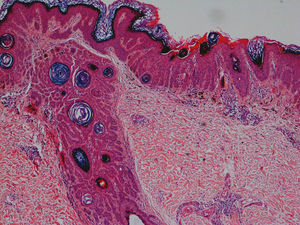 Histopathology of a lesion biopsied from the perianal skin: basal hyperpigmentation, digitiform rete ridges, antler-like suprapapillary thinning, dermal melanophages, and a mild perivascular lymphohistiocytic infiltrate (hematoxylin and eosin, original magnification ×10).