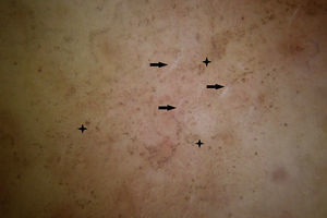 Dermoscopy: Wickham striae (arrows) together with grayish-brown dots and globules following the Wickham striae or clustered in the depressed center of these lesions in the form of ashy holes (asterisks).