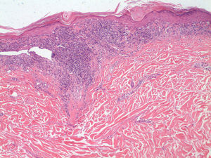A dense band-like inflammatory infiltrate can be seen at the interface, with vacuolar degeneration of the basal layer and scattered apoptotic keratinocytes (hematoxylin and eosin, original magnification ×10).