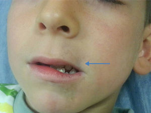 Depressed linear lesion on the left upper lip in our patient.