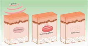 Principle of selective photothermolysis.