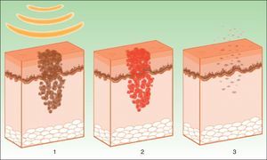 Mechanism of action of intense pulsed light in pigmented lesions.19 Melanosomes absorb the light (1), which is converted to heat (2), whereupon epidermolysis occurs and the lesion is eliminated (3).