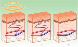 Mechanism of action of intense pulsed light in vascular lesions. Hemoglobin captures energy (1), leading to coagulation in the vessel (2), which is subsequently destroyed (3).