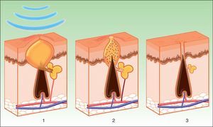 Mechanism of action of intense pulsed light in the treatment of acne. Porphyrins produced by Propionibacterium acnes act as chromophores (1), and release bactericidal free radicals and stimulate antiinflammatory cytokine release (TGF- β) along with photothermolysis of the vessels that supply the sebaceous glands (2). Inflammation is eliminated and the glands are reduced (3).