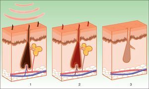 Mechanism of action of intense pulsed light in photoepilation. Melanin in the hair shaft and stem cells in the papillary dermis act as chromophores (1), the energy is transformed into thermal energy (2), leading to necrosis of the hair bulb (3).