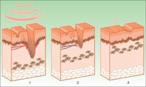 Neocollagenosis induced by intense pulsed light. The thermal damage to the dermis induces fibroblast activation (1), with the resulting formation of neocollagen, along with elimination of telangiectasias and pigmented lesions (2 and 3).