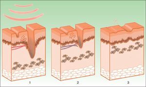 Neocollagenosis induced by intense pulsed light. The thermal damage to the dermis induces fibroblast activation (1), with the resulting formation of neocollagen, along with elimination of telangiectasias and pigmented lesions (2 and 3).