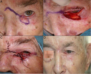 A, Basal cell carcinoma that infiltrated the punctum. B, Full-thickness resection leaving a defect of more than half of the lower eyelid. C, Double flap: glabellar flap and advancement flap of the lower eyelid. D, Final outcome showing slight thickening of the skin of the flap, which was corrected in a second operation.