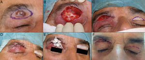 A, Basal cell carcinoma of 2.5×1.5cm on the upper eyelid. B, Defect after tumor excision. C, If closed directly, lagophthalmos would occur. D and E, Full-thickness skin graft from the contralateral eyelid and dressing sutured into place. F, Result the day of removal of the sutures.