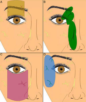 Regional nerve blocks: A, Supraorbital nerve; B, Supratrochlear and infratrochlear nerves, nasociliary nerve, and external nasal branch of the anterior ethmoidal nerve; C, Infraorbital nerve: D, Zygomatico-facial, zygomatico-temporal, and lacrimal nerves. Figure courtesy of Dr. F. J. Vázquez Doval.5