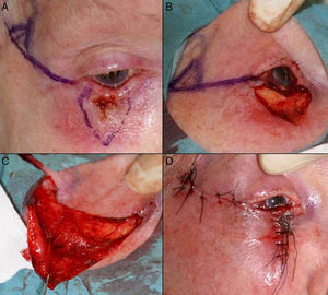 A, Squamous cell carcinoma that produced retraction, provoking ectropion. B, V-shaped en bloc full-thickness resection leaving a defect greater than half of the lower eyelid. C, Cantholysis and an advancement flap. D, Suture with 4/0 and 5/0 silk, with long suture ends on the lower eyelid to avoid abrasion against the cornea. Eyelid edema and hematoma and hyposphagma (subconjunctival hemorrhage).