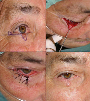 A, Basal cell carcinoma affecting the free border of the eyelid. B, The defect created was less than a quarter of the lower eyelid and an advancement flap was designed with a Burow triangle in the area adjacent to the lateral canthus. C, Suture with 5/0 silk. D, Result 20 days after the operation. The scar perpendicular to the free border prevented ectropion.