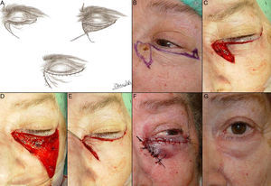 A, Design of an advancement flap. Drawing by Zaira González Fernández. B, Basal cell carcinoma at the medial canthus. C-E, Advancement flap for the lower eyelid and Burow triangle at the lateral canthus. F, Suture with 5/0 silk. Hematoma in the lower eyelid. G, Outcome 1 month after the operation.