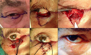 A, Poorly-defined squamous cell carcinoma that affected the lower eyelid up to its free border. B, Excision of the lesion, which included the full-thickness of the eyelid. C, Reconstruction using a double mucosal and myocutaneous V-Y advancement flap. D and E, V-Y advancement flap with a subcutaneous pedicle, sutured with 5/0 silk. F, Result 1 month after the operation, with slight exposure of the sclera.