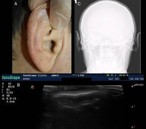 A, Ear of seemingly normal appearance, though palpably stiff. B, Skin ultrasound showing a hyperechoic band over the normally hypoechoic auricular cartilage. C, Cranial x-ray showing a bone-type increase in the opacity of the auricles of the ear.