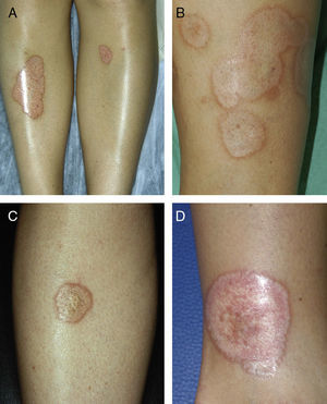 Characteristic lesions of necrobiosis lipoidica in the pretibial region (A, B, and C) and on the ankle (D). The lesions have a well-defined erythematous border and an atrophic center with a mottled appearance.