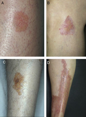 Characteristic lesions of necrobiosis lipoidica on the lower extremities, with a predominance of telangiectasia (A and B), yellowish coloring (C), and atrophy (D).