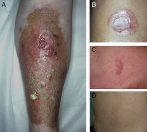 A, Extensive necrobiosis lipoidica with ulcerated areas and keratotic areas (patient 18). B, Necrobiosis lipoidica lesion that was previously ulcerated in the pretibial area and that has completely re-epithelialized (patient 16). C, Characteristic lesion of granuloma annulare in the clavicular area of patient 22. D, Disseminated granuloma annulare on the abdomen of patient 29.