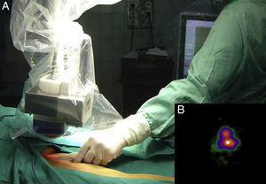 A, Location of surgical incision site using a portable gamma camera. B, Image of sentinel node produced by the camera.