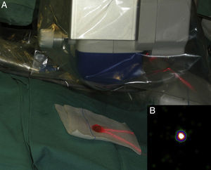 A, Capturing of ex vivo images of a dissected sentinel node using the portable gamma camera. B, Image confirming that the node is actually a sentinel node.