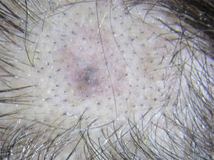 Clinical image of the lesion, an asymptomatic brown macule with poorly defined edges located on the apex of the scalp.