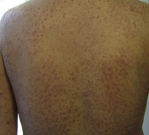 Well defined, brownish erythematous nodules of elastic consistency on the back.