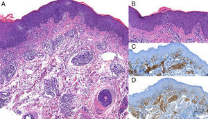 A, Image shows a superficial diffuse infiltrate and a nodular infiltrate located predominantly in the papillary and reticular dermis beneath an orthokeratotic epidermis with moderate acanthosis; hematoxylin-eosin, original magnification ×4. B, Image shows thickened dermal collagen and a predominantly lymphocytic infiltrate showing some epidermotropism; hematoxylin-eosin, original magnification ×20. C, CD3+, original magnification ×2: intense staining of lymphocytic infiltrate. D, CD4+, original magnification ×2: most lymphocytes are stained with this immunohistochemical marker.