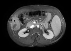 Magnetic resonance imaging scan (gadolinium-enhanced fat-saturated T1-weighted image). Metastastic lesion on the right abdominal wall adjacent to the lower pole of the liver (*) with cutaneous involvement (**).
