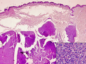 Excisional skin biopsy (hematoxylin-eosin, original magnification X40). Infiltration of the dermis and adipose tissue by hepatocellular carcinoma. Contact with the deep surgical margin.