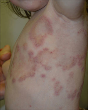 Multiple annular and polycyclic erythematous plaques with purpuric macules and indurated borders devoid of crusts, vesicles or desquamation distributed along her left chest and axillae.